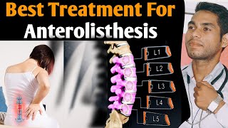 anterolisthesis l5 s1 treatment Spondylolisthesis grade 1 treatment exercises grade 2 l4 L5 Hindi [upl. by Goldia867]