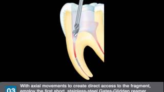 StepbyStep Using Komets Endo Rescue Kit 4601 for removing instrument fragments [upl. by Kendry]