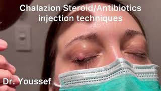 Chalazion Easiest and simplest Treatment with Steroid and Antibiotic Injections [upl. by Conway933]