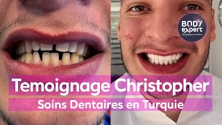 SOINS DENTAIRES  🦷 Témoignage facettes dentaires  BODYEXPERT [upl. by Becky617]