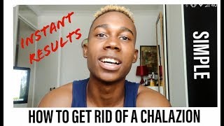 HOW TO GET RID OF A CHALAZION  instant results [upl. by Inasah]