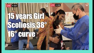 TOP 3 Most  15 years Girl Scoliosis 38° 16° curve Problems [upl. by Yecniuq]