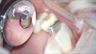 Subgingival prep technique [upl. by Nysilla]