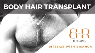 Body Hair Transplant Advantages amp Limitations  Bitesize with Bisanga Ep 16 [upl. by Nhguavahs769]