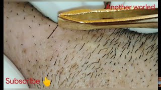 How to Remove an Ingrown Hairon the face 2019ingrown hair treatment [upl. by Croteau986]