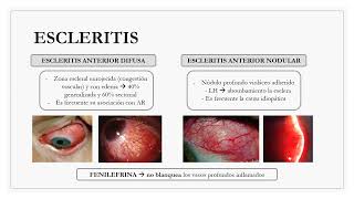 Apuntes de Oftalmología de Ojitos de Flor  ESCLERITIS Y EPIESCLERITIS [upl. by Atikin]