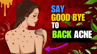 Home Remedies For Back Acne  How to Get Rid of Acne  Pimples on Back [upl. by Anorahs]