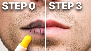 Chapped Lips By Dr Rashmi Shetty [upl. by Amlas250]