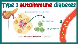 Type 1 diabetes autoimmune diabetes  cause and consequences [upl. by Clio695]