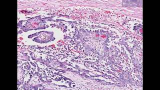 OVARIAN TUMORS  Part 2  SEROUS AND MUCINOUS TUMORS Etiopathogenesis and morphology [upl. by Nyllij]