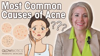 The Main Causes of Acne amp How To Combat Acne Prone Skin  GLOWBIOTICS [upl. by Asirak134]