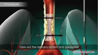 SampG BiotechEGIS Airway Stent [upl. by Godrich79]