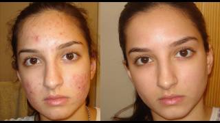 A true miracle How I got rid of my acne Daily skincare routine [upl. by Rehtse]