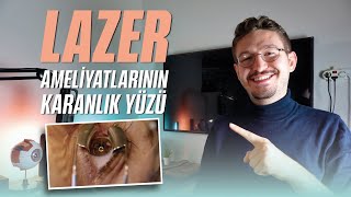 Göz çizdirme ameliyatı neden olmuyorum Göz Lazer Ameliyat Riskleri [upl. by Nesnar]