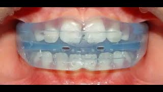 Interceptive Orthodontics [upl. by Trainor]