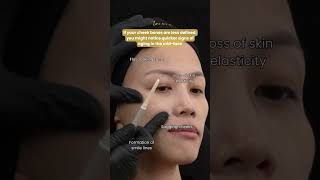 Restylane Lyft Cheek Filler on Asian Features [upl. by Kamerman]