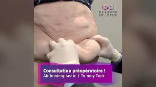 ABDOMINOPLASTIE MON EXPERIENCE😥 [upl. by Campball]