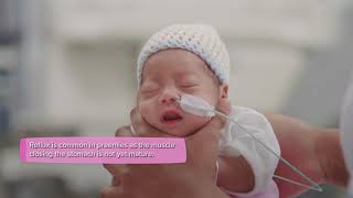 Premature baby  Nutrition and feeding [upl. by Lanny383]