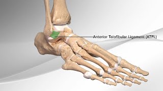 Chronic Ankle Sprain Repair With the InternalBrace™ Ligament Augmentation Procedure [upl. by Nyrmac]