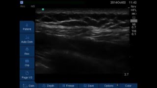 Serratus Plane Block [upl. by Maurilla]