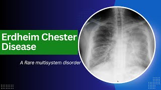 ERDHEIM CHESTER DISEASE  A Rare multisystem disorder [upl. by Marlette175]