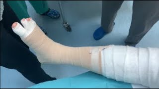 Compression Bandaging for lymphedema of the leg [upl. by Ggerk]