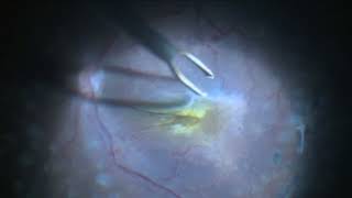 Epi Retinal gliosis Removal [upl. by Ttenrag]