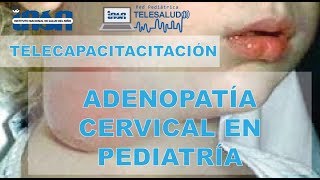 Adenopatía Cervical en Pediatría  Telecapacitación INSN [upl. by Korie298]