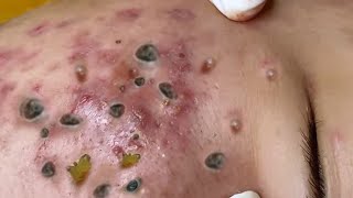 Big Cystic Acne Blackheads Extraction Blackheads amp Milia Whiteheads Removal Pimple Popping [upl. by Norm]