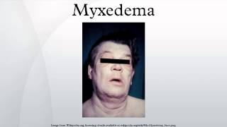 Myxedema [upl. by Nylarej]