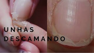 UNHAS QUE DESCAMAM  POR QUE E COMO TRATAR [upl. by Denyse]