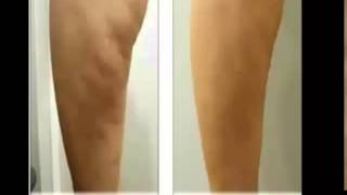 Comment Perdre De La Cellulite  Cellulite Solution [upl. by Merriman]