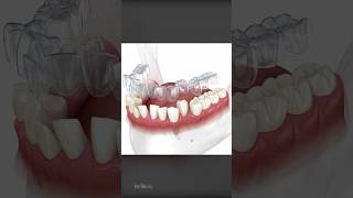 How Does Invisalign Aligners Work To Straighten Teeth [upl. by Knepper226]