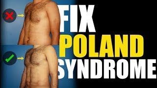 What is Poland Syndrome in Men [upl. by Aicileb]