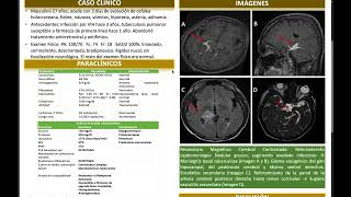 Tratamiento Exitoso de Meningoencefalitis Tuberculosa Drogoresistente en un Paciente con SIDA [upl. by Ushijima296]