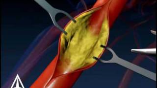 Carotid Endarectomy  3D Medical Animation [upl. by Garrek]