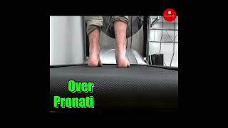 Discover the secrets of Over Pronation in our latest video Stay informed stay healthy [upl. by Tyoh]