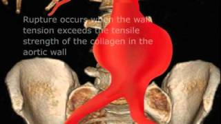 Ruptured Abdominal Aortic Aneurysm [upl. by Nosnek]