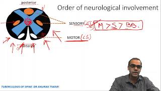 Ortho 21 Tuberculosis of spine [upl. by Hilarius886]