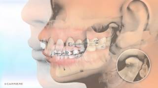 Carriere® Motion™ Appliance for Class II Patients  Braces and Invisalign Ortho  Madison GA [upl. by Wolpert]