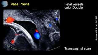 Vasa Previa  ultrasound diagnosis [upl. by Aser]