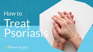 Psoriasis Treatment  Explained by Dermatologist [upl. by Nimad]