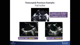 Course 13 Percutaneous Transseptal Access TMVR amp Mitral ValveinValve Replacement [upl. by Georgette]