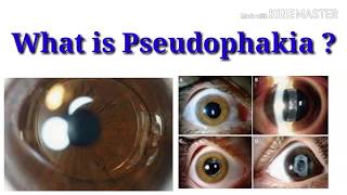 What is pseudophakia  sign  Intraocular lens  sharp vision [upl. by Adnwahsor214]