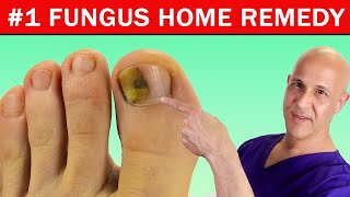 1 Best Home Remedy Cure for Toenail Fungus Dr Mandell [upl. by Higinbotham]