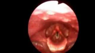 Flexible Video Stroboscopy Exam Kansas Voice Center [upl. by Anirrok]