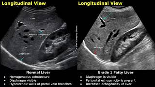 Fatty Liver Grading On Ultrasound  USG Normal Vs Abnormal Images  Grades 12 amp 3 Hepatic Steatosis [upl. by Asel]