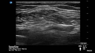 Ultrasound Guided Popliteal Sciatic Nerve Blockade with Catheter Placement [upl. by Elenahc]