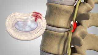 Herniated Disc  Patient Education [upl. by Aizahs]