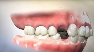 Removing Teeth for Braces  Why Extracting and Retracting Orthodontics is harmful [upl. by Klotz]